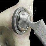 depuy hip implant recall 150x1501 embed medium 9a1bda91